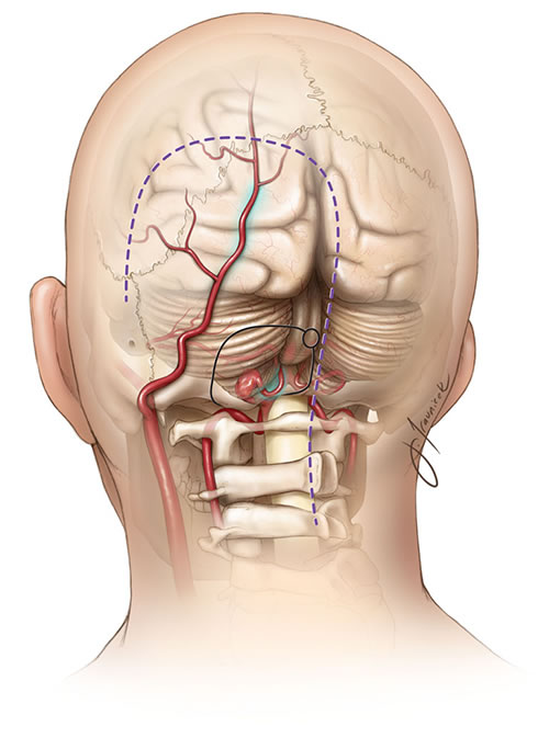 Аневризмы, расположенные в проксимальной части задней нижней мозжечковой артерии (PICA), могут нуждаться в клиппировании с сопутствующим обходным анастомозом. В этом случае анастомоз конец-в-бок между затылочной артерией и PICA является одним из вариантов профилактики медиального поражения продолговатого мозга.